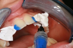 El reto estaba en imitar el esmalte que presenta el borde de los dientes a tratar y las zonas blanquecinas
